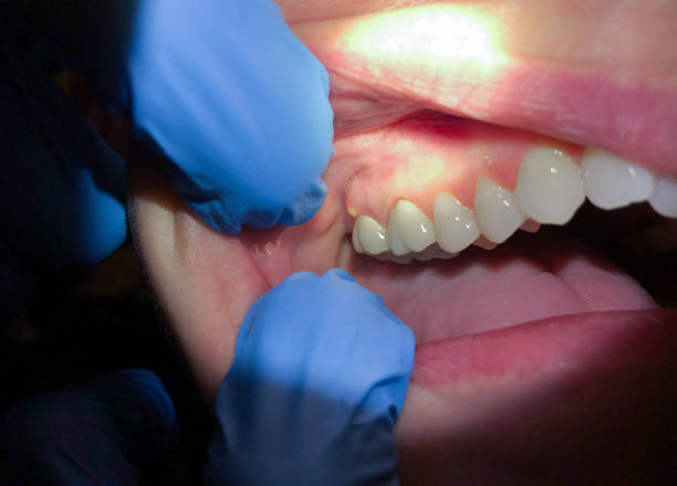 Best Teeth Whitening  in Holgate, OH