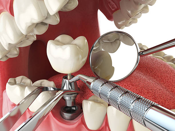 Best Broken Tooth Emergency  in Holgate, OH